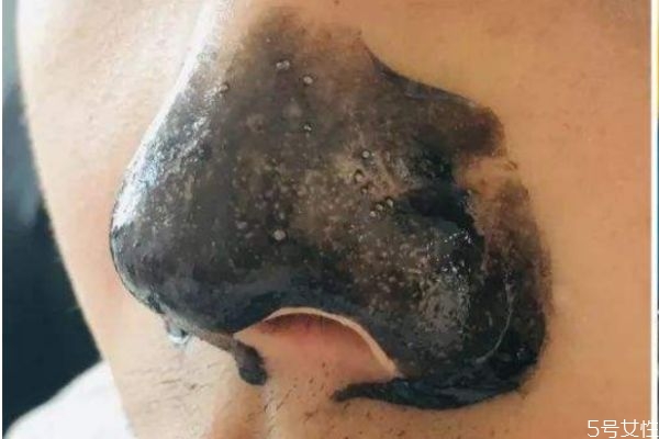 去除草莓鼻的方法 草莓鼻應(yīng)該怎么消除 去除草莓鼻的方法 草莓鼻應(yīng)該怎么消除