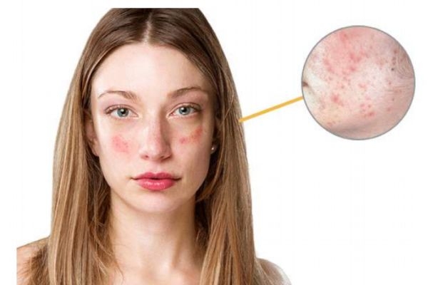 香蕉面膜可以改善紅血絲嗎 香蕉面膜改善紅血絲有效果嗎 香蕉面膜可以改善紅血絲嗎 香蕉面膜改善紅血絲有效果嗎