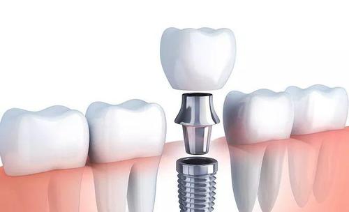 種植牙齒多少錢一顆 種植牙齒的價(jià)格受什么影響