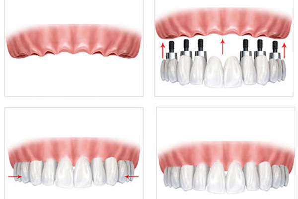 種植牙齒要注意什么 種植牙齒不能吃什么 種植牙齒要注意什么 種植牙齒不能吃什么