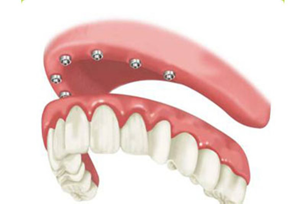 種植牙齒后牙齦紅腫正常嗎 種植牙齒后牙齦紅腫怎么辦 種植牙齒后牙齦紅腫正常嗎 種植牙齒后牙齦紅腫怎么辦