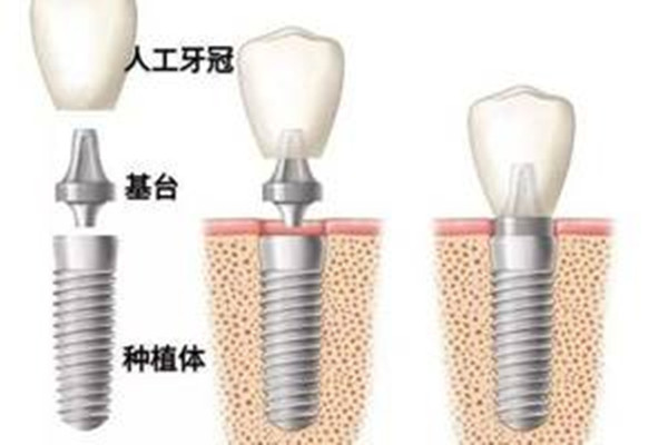種植牙齒的好處 種植牙齒的優(yōu)點 種植牙齒的好處 種植牙齒的優(yōu)點