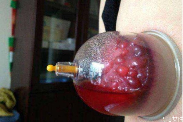 拔罐出水泡怎么回事 為什么拔罐會出水泡 拔罐出水泡怎么回事 為什么拔罐會出水泡