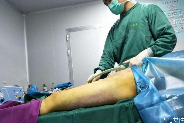 腿部抽脂多久能恢復(fù) 腿部抽脂恢復(fù)時(shí)間 腿部抽脂多久能恢復(fù) 腿部抽脂恢復(fù)時(shí)間