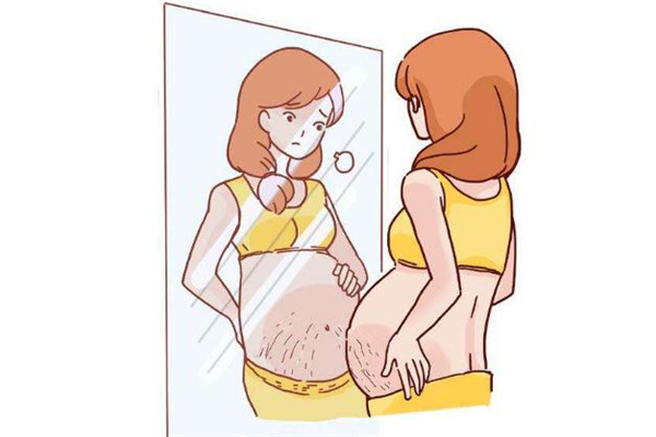 激光去妊娠紋真的有用嗎 激光去妊娠紋效果好嗎 激光去妊娠紋真的有用嗎 激光去妊娠紋效果好嗎