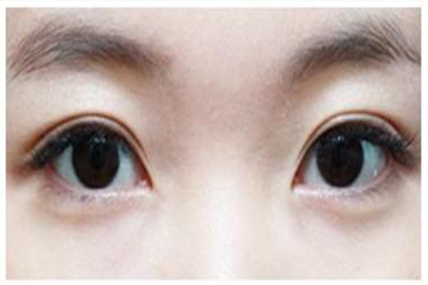 壓雙眼皮要多久恢復(fù) 壓雙眼皮有痛感嗎 壓雙眼皮要多久恢復(fù) 壓雙眼皮有痛感嗎