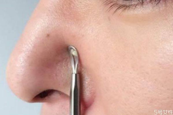 挑完粉刺后可不可以洗臉 粉刺挑完多久才能洗臉 挑完粉刺后可不可以洗臉 粉刺挑完多久才能洗臉