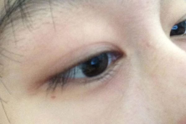 無痕去眼袋的恢復期有多久 無痕去眼袋的原理 無痕去眼袋的恢復期有多久 無痕去眼袋的原理