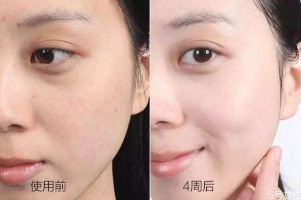 額頭長閉口是什么情況 為什么額頭反復(fù)長閉口 額頭長閉口是什么情況 為什么額頭反復(fù)長閉口