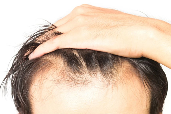 什么是毛發(fā)移植 毛發(fā)移植安全嗎 什么是毛發(fā)移植 毛發(fā)移植安全嗎