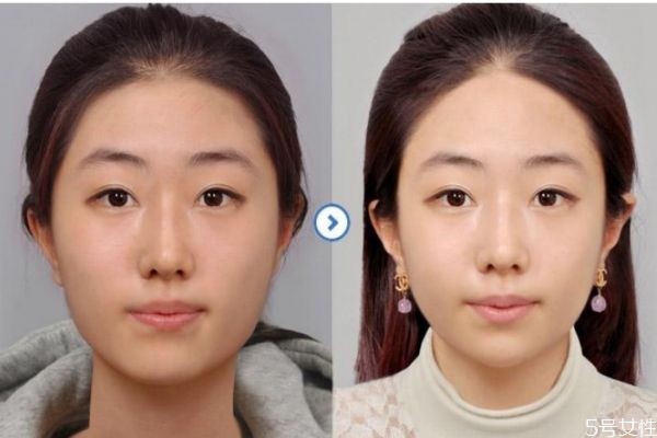 夏天打瘦臉針要注意什么 瘦臉針夏天打好還是冬天打好 夏天打瘦臉針要注意什么 瘦臉針夏天打好還是冬天打好