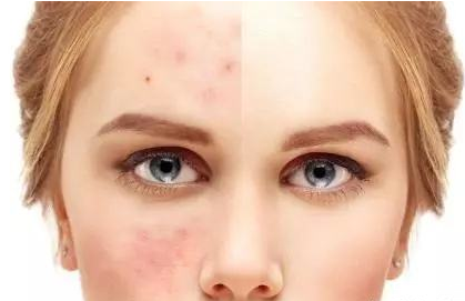 刷酸爆痘要不要繼續(xù)刷 刷酸爆痘怎么辦 刷酸爆痘要不要繼續(xù)刷 刷酸爆痘怎么辦