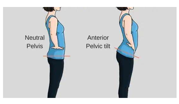 骨盆前傾是怎么造成的 什么睡姿可以矯正骨盆前傾 骨盆前傾是怎么造成的 什么睡姿可以矯正骨盆前傾