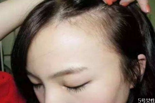 發(fā)際線后移怎么解決 發(fā)際線后移能恢復(fù)嗎 發(fā)際線后移怎么解決 發(fā)際線后移能恢復(fù)嗎