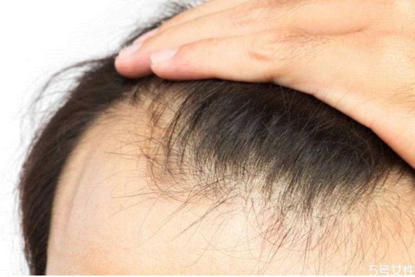 發(fā)際線后移怎么解決 發(fā)際線后移能恢復(fù)嗎 發(fā)際線后移怎么解決 發(fā)際線后移能恢復(fù)嗎