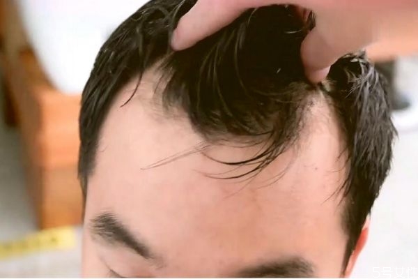 m字型發(fā)際線怎么辦 m型發(fā)際線一定會(huì)禿頂嗎 m字型發(fā)際線怎么辦 m型發(fā)際線一定會(huì)禿頂嗎