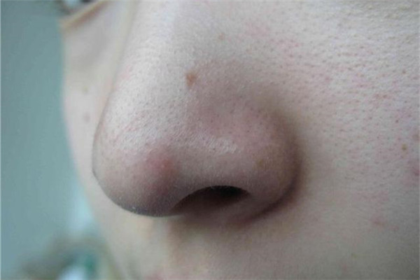 鼻子兩側(cè)毛孔粗大原因及怎么改善 鼻子兩側(cè)毛孔粗大原因及怎么改善