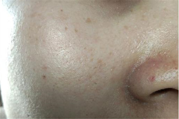 鼻子兩側(cè)毛孔粗大原因及怎么改善 鼻子兩側(cè)毛孔粗大原因及怎么改善