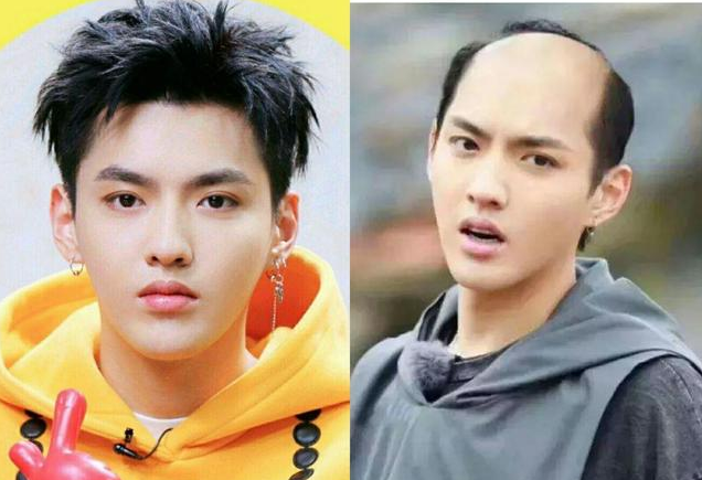 怎么解決發(fā)際線后移 發(fā)際線后移我們該如何挽救 怎么解決發(fā)際線后移 發(fā)際線后移我們該如何挽救