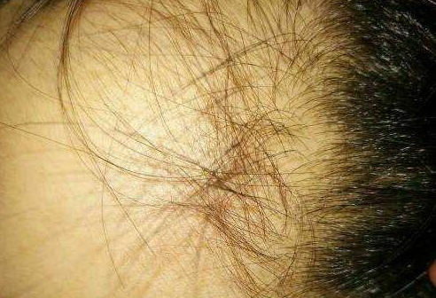 經常掉頭發(fā)的人身體是缺什么營養(yǎng) 經常掉頭發(fā)的人身體是缺什么營養(yǎng)