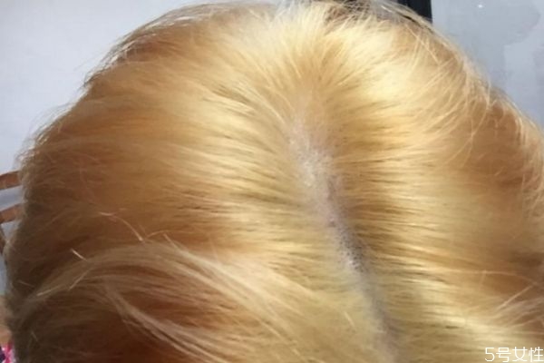 漂發(fā)可以連續(xù)兩次嗎 漂發(fā)和染發(fā)有啥區(qū)別 漂發(fā)可以連續(xù)兩次嗎 漂發(fā)和染發(fā)有啥區(qū)別
