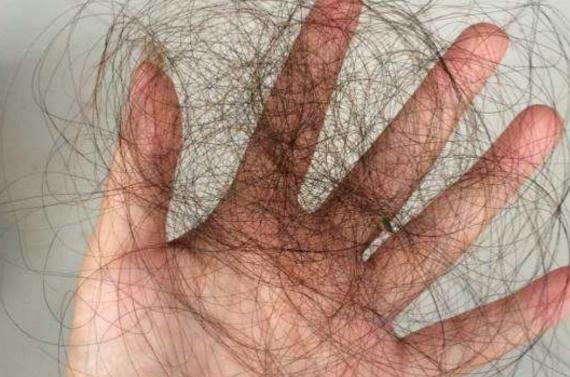 產(chǎn)后脫發(fā)嚴(yán)重怎么治療才有效 產(chǎn)后脫發(fā)原因是什么 產(chǎn)后脫發(fā)嚴(yán)重怎么治療才有效 產(chǎn)后脫發(fā)原因是什么