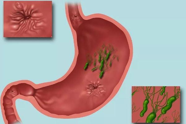 胃潰瘍要吃多久的藥才能修復(fù) 胃潰瘍要做活檢嗎 胃潰瘍要吃多久的藥才能修復(fù) 胃潰瘍要做活檢嗎