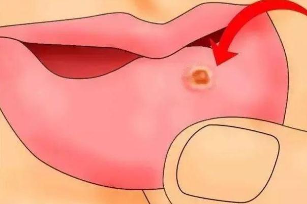 口腔潰瘍有什么土方法 口腔潰瘍有什么偏方 口腔潰瘍有什么土方法 口腔潰瘍有什么偏方