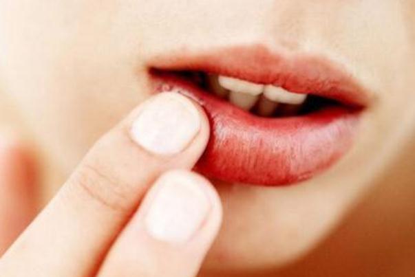 口腔潰瘍有膿 口腔潰瘍有膿如何處理 口腔潰瘍有膿 口腔潰瘍有膿如何處理