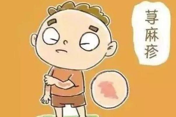 蕁麻疹的癥狀有哪些 蕁麻疹的治療方法哪種好 蕁麻疹的癥狀有哪些 蕁麻疹的治療方法哪種好