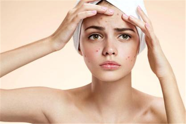 夏天臉上長痘痘怎么回事 為什么夏天臉上愛長痘 夏天臉上長痘痘怎么回事 為什么夏天臉上愛長痘