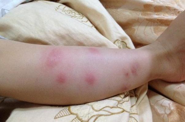 新生兒濕疹能曬太陽嗎 新生兒濕疹能用碘伏嗎 新生兒濕疹能曬太陽嗎 新生兒濕疹能用碘伏嗎