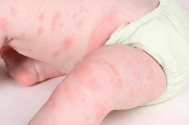 新生兒濕疹怎么治療最好的方法 新生兒濕疹是什么引起的 新生兒濕疹怎么治療最好的方法 新生兒濕疹是什么引起的