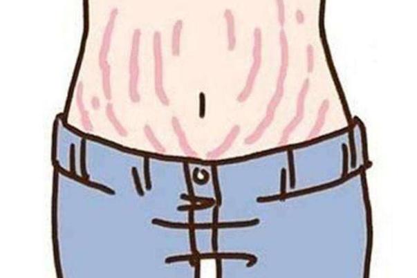 妊娠紋是什么原因引起的 妊娠紋多久會(huì)自然淡化 妊娠紋是什么原因引起的 妊娠紋多久會(huì)自然淡化