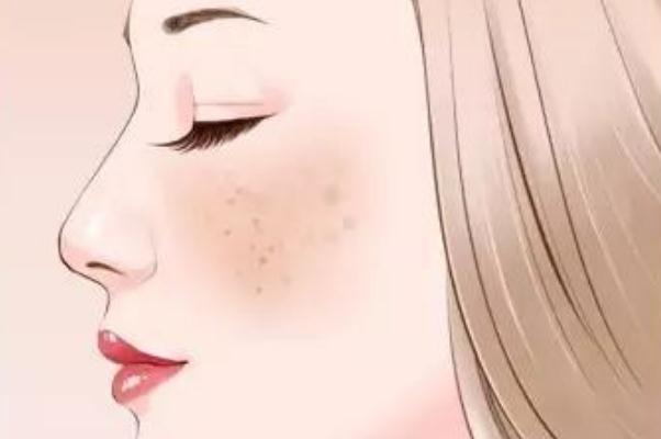 妊娠斑是怎么形成的 妊娠斑怎么調理可以淡斑 妊娠斑是怎么形成的 妊娠斑怎么調理可以淡斑