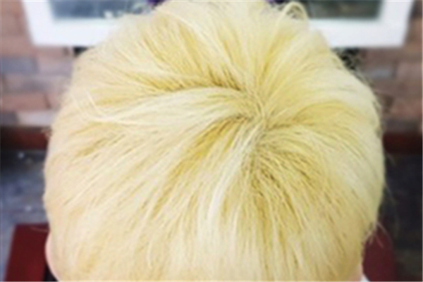 漂發(fā)后頭皮結(jié)痂用什么藥 漂發(fā)后頭皮結(jié)痂會禿嗎 漂發(fā)后頭皮結(jié)痂用什么藥 漂發(fā)后頭皮結(jié)痂會禿嗎