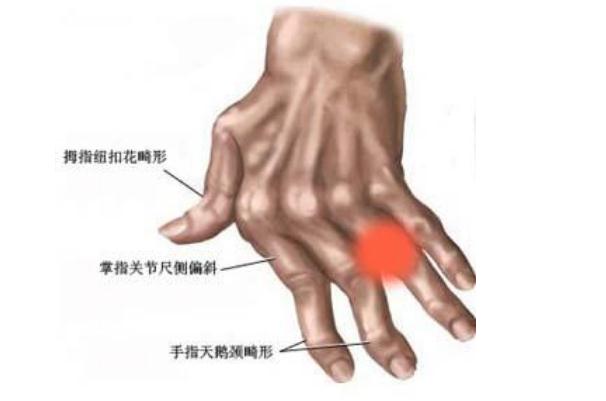 風(fēng)濕病可以根治嗎 風(fēng)濕病可以吹空調(diào)嗎 風(fēng)濕病可以根治嗎 風(fēng)濕病可以吹空調(diào)嗎