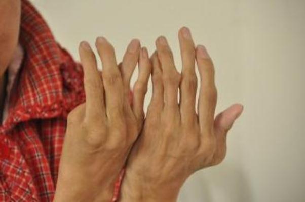 風(fēng)濕病有哪些癥狀 風(fēng)濕病怎么治最好的方法 風(fēng)濕病有哪些癥狀 風(fēng)濕病怎么治最好的方法