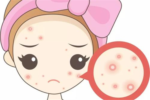 痘痘肌適合用什么洗面奶 痘痘肌膚怎么調(diào)理小常識 痘痘肌適合用什么洗面奶 痘痘肌膚怎么調(diào)理小常識