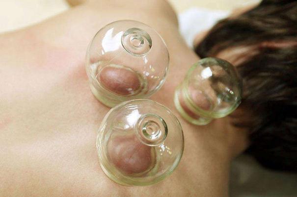 拔火罐會(huì)引起月經(jīng)推遲嗎 拔火罐會(huì)影響月經(jīng)嗎 拔火罐會(huì)引起月經(jīng)推遲嗎 拔火罐會(huì)影響月經(jīng)嗎