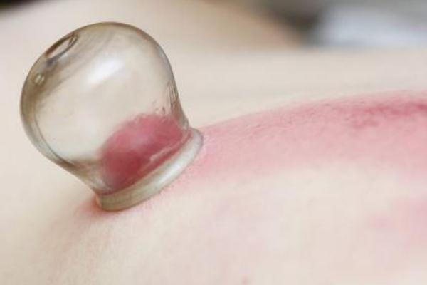 拔火罐后皮膚黑紫原因 拔火罐的顏色代表什么 拔火罐后皮膚黑紫原因 拔火罐的顏色代表什么