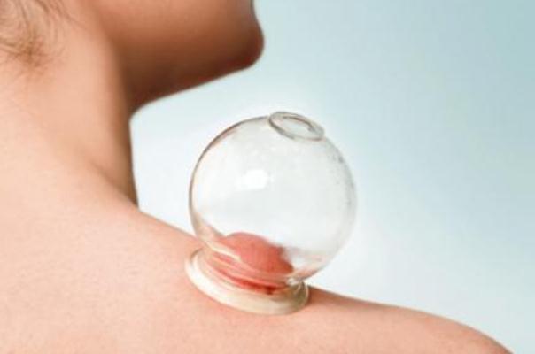 拔火罐后皮膚黑紫原因 拔火罐的顏色代表什么 拔火罐后皮膚黑紫原因 拔火罐的顏色代表什么