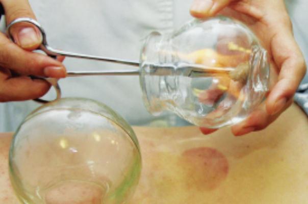 拔火罐后皮膚黑紫原因 拔火罐的顏色代表什么 拔火罐后皮膚黑紫原因 拔火罐的顏色代表什么