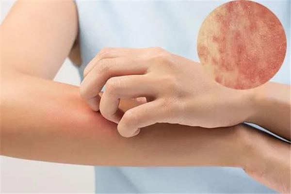 蕁麻疹老是反復(fù)發(fā)作怎么回事 蕁麻疹反復(fù)發(fā)作怎么才能根除 蕁麻疹老是反復(fù)發(fā)作怎么回事 蕁麻疹反復(fù)發(fā)作怎么才能根除