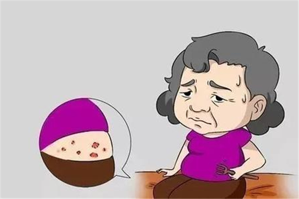 蕁麻疹會(huì)引起頭皮癢嗎 蕁麻疹有什么表現(xiàn)癥狀 蕁麻疹會(huì)引起頭皮癢嗎 蕁麻疹有什么表現(xiàn)癥狀