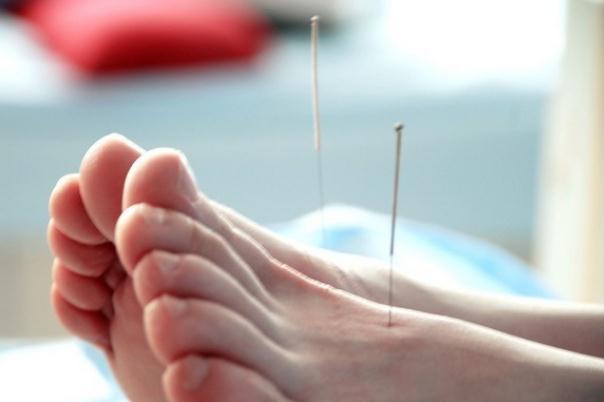 針灸會影響月經(jīng)推遲嗎 針灸會導(dǎo)致月經(jīng)不調(diào)嗎 針灸會影響月經(jīng)推遲嗎 針灸會導(dǎo)致月經(jīng)不調(diào)嗎