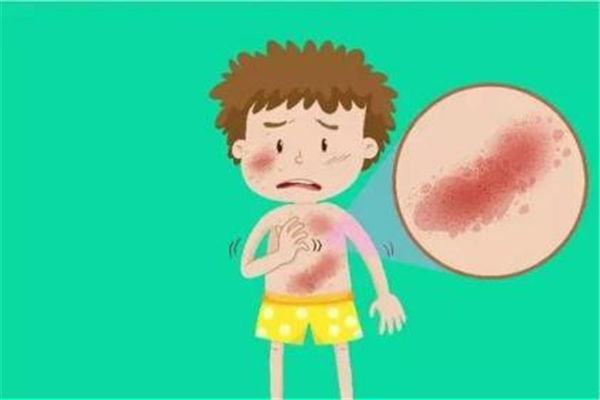 蕁麻疹能根治嗎 蕁麻疹怎么治療根除 蕁麻疹能根治嗎 蕁麻疹怎么治療根除
