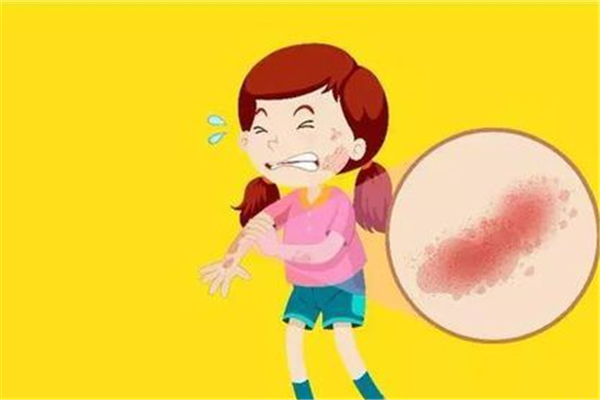 蕁麻疹是什么原因引起的 蕁麻疹有幾種 蕁麻疹是什么原因引起的 蕁麻疹有幾種