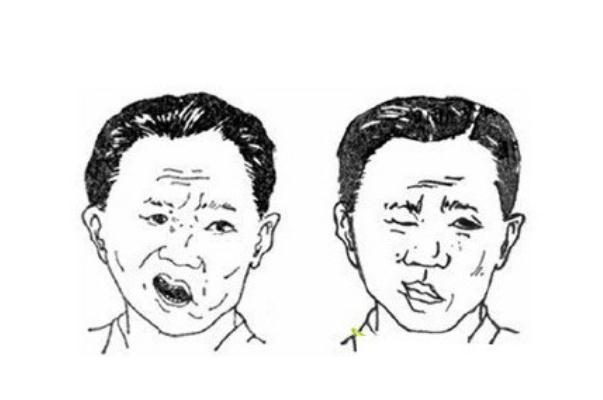 面癱怎么治療 面癱怎么治療好得快 面癱怎么治療 面癱怎么治療好得快