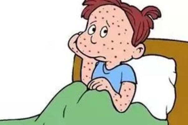 水痘初期癥狀 水痘多久能好 水痘初期癥狀 水痘多久能好